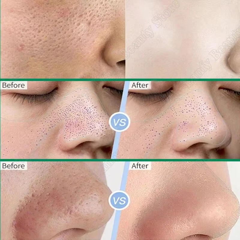 Krim Pembersih Pori Asam Salis - Salicylic Acid Blackhead Remover ulasan dan harga